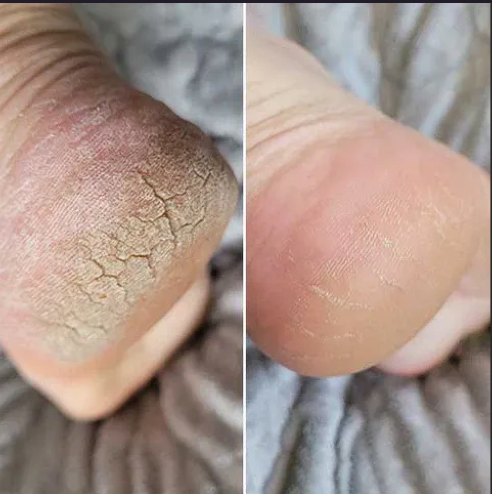 NoevatFeet Pro™ – Lime Électrique Anti-Callosités