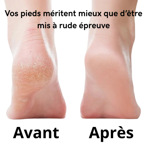 NoevatFeet Pro™ – Lime Électrique Anti-Callosités